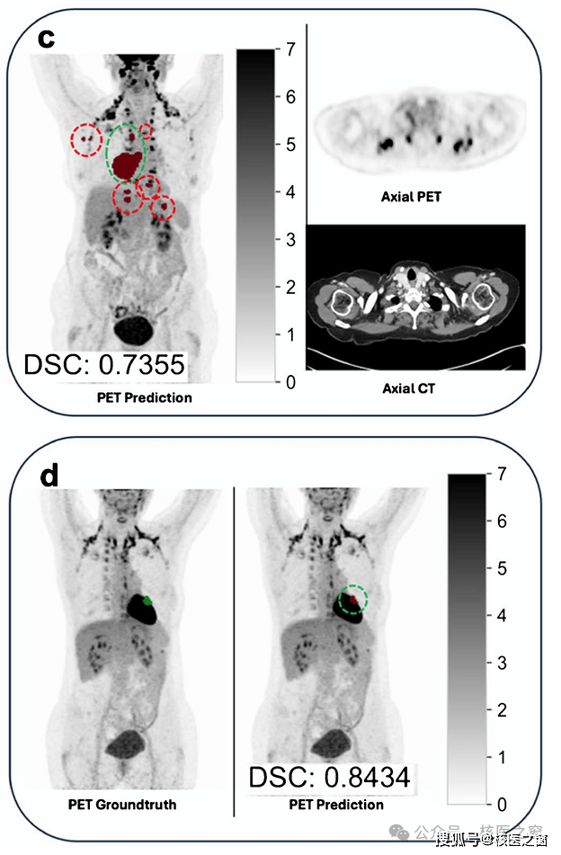 麦澜德获得发明专利授权：“多模态信息融合的神经肌肉状态AI实时定量评估方法”